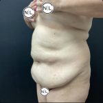 Abdominoplasty Before & After Patient #15902
