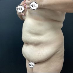 Abdominoplasty Before & After Patient #15902
