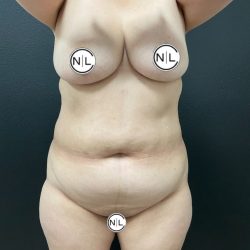 Abdominoplasty Before & After Patient #15903
