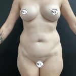 Abdominoplasty Before & After Patient #15955