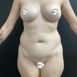 Abdominoplasty Before & After Patient #15955