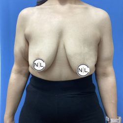 Breast Reduction Before & After Patient #15957