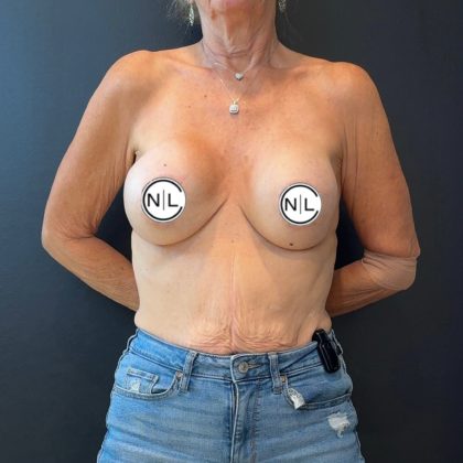 Breast Revision Before & After Patient #15905