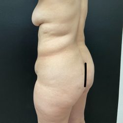 Brazilian Butt Lift Before & After Patient #15906