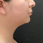 Jawline/Neck Before & After Patient #15907