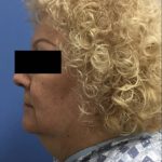 Jawline/Neck Before & After Patient #15953