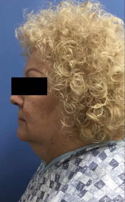 Jawline/Neck Before & After Patient #15953