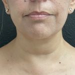 Jawline/Neck Before & After Patient #15989