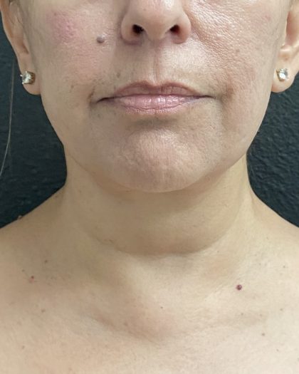 Jawline/Neck Before & After Patient #15989