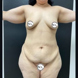 Mommy Makeover Before & After Patient #15909