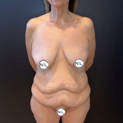 Mommy Makeover Before & After Patient #15910