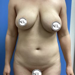 Mommy Makeover Before & After Patient #15990