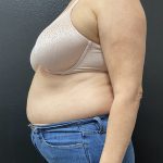 Weight Loss Before & After Patient #15901