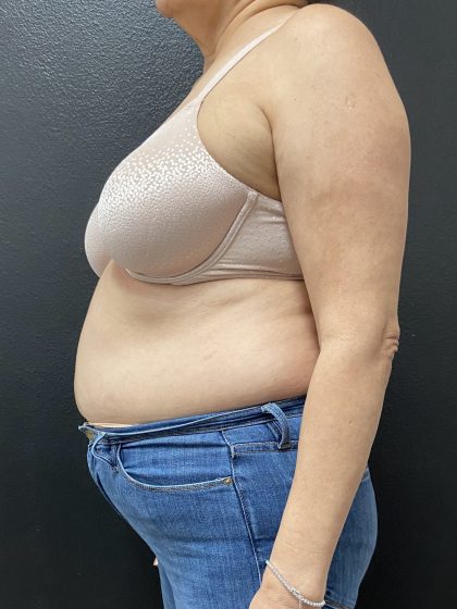 Weight Loss Before & After Patient #15901