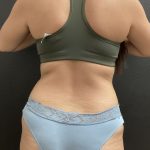 Weight Loss Before & After Patient #15954