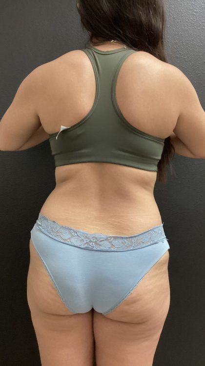 Weight Loss Before & After Patient #15954