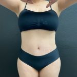 Abdominoplasty Before & After Patient #15900