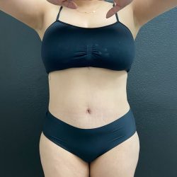 Abdominoplasty Before & After Patient #15900