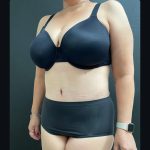 Abdominoplasty Before & After Patient #15902
