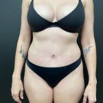 Abdominoplasty Before & After Patient #15955