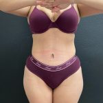 Abdominoplasty Before & After Patient #15959