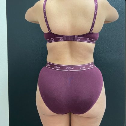 Brazilian Butt Lift Before & After Patient #15958