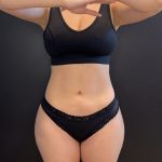 Liposuction Before & After Patient #15988