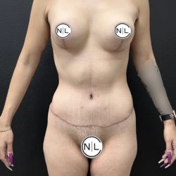Mommy Makeover Before & After Patient #15960