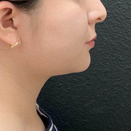 Jawline/Neck Before & After Patient #15907