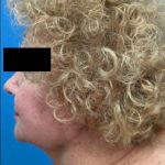 Jawline/Neck Before & After Patient #15953