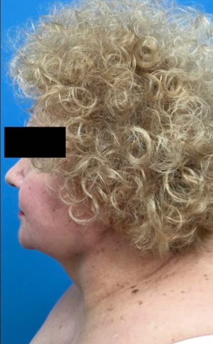 Jawline/Neck Before & After Patient #15953