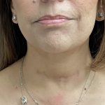 Jawline/Neck Before & After Patient #15989