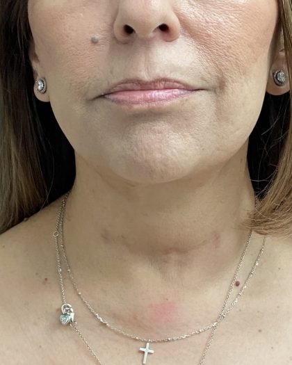 Jawline/Neck Before & After Patient #15989