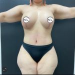 Mommy Makeover Before & After Patient #15909