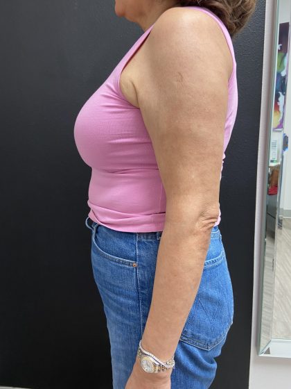 Weight Loss Before & After Patient #15901
