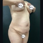 Abdominoplasty Before & After Patient #15900