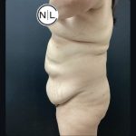 Abdominoplasty Before & After Patient #15902