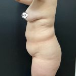 Abdominoplasty Before & After Patient #15903