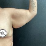 Brachioplasty Before & After Patient #15956