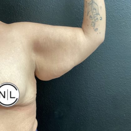 Brachioplasty Before & After Patient #15956