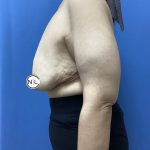 Breast Reduction Before & After Patient #15957