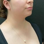 Jawline/Neck Before & After Patient #15907
