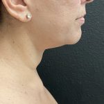 Jawline/Neck Before & After Patient #15989