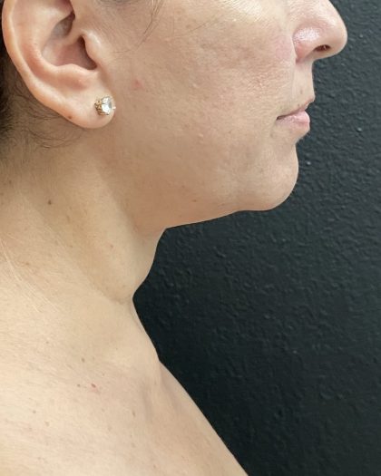 Jawline/Neck Before & After Patient #15989