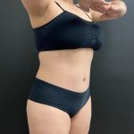 Abdominoplasty Before & After Patient #15900