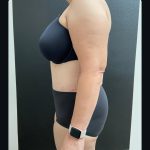 Abdominoplasty Before & After Patient #15902