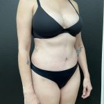 Abdominoplasty Before & After Patient #15955