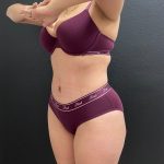 Abdominoplasty Before & After Patient #15959