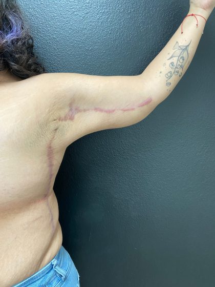 Brachioplasty Before & After Patient #15956