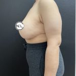 Breast Reduction Before & After Patient #15957